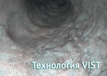 Технология VIST Sonoscape