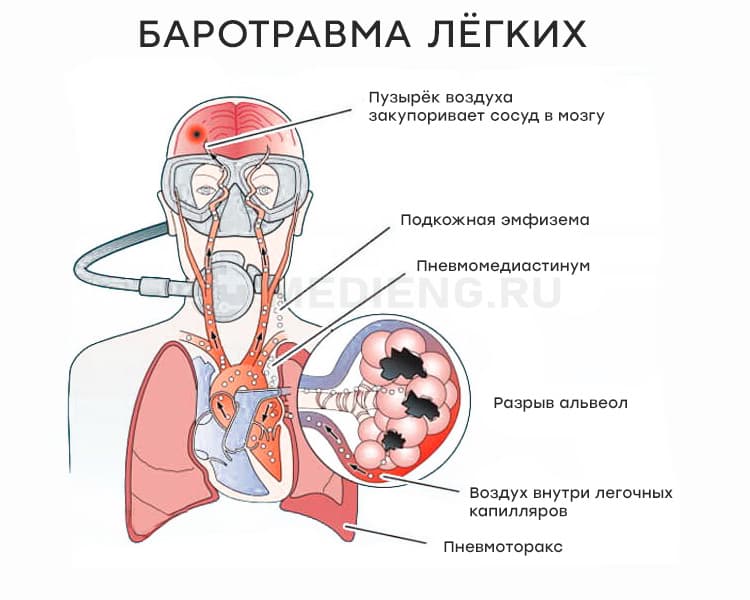 Что такое баротравма лёгких