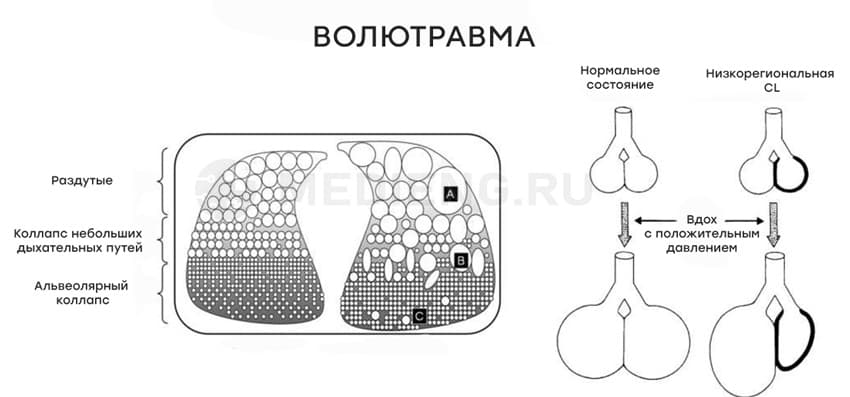 Что такое волютравма